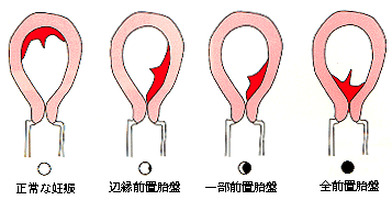 せックス後 出血 妊娠初期